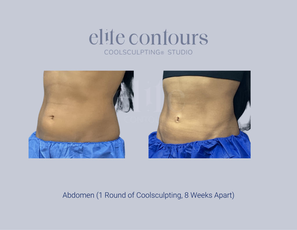 CoolSculpting abdomen before and after Lewisville TX