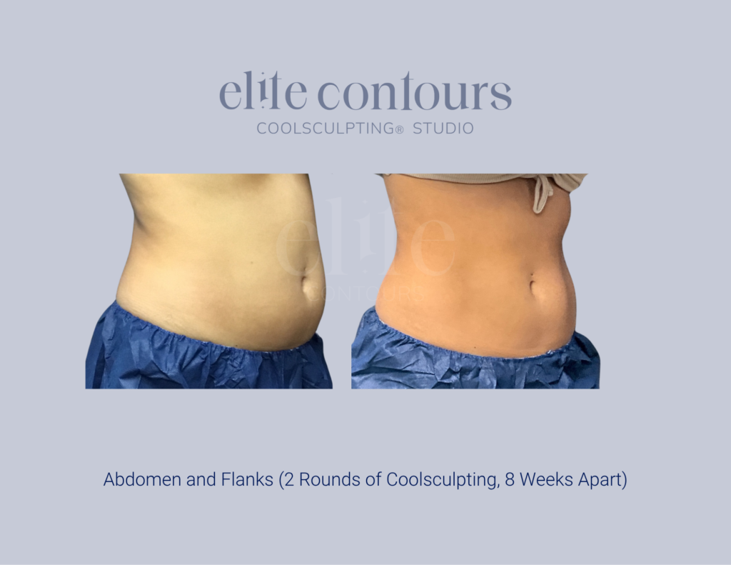 CoolSculpting abdomen before and after photo female client treated in Lewisville, TX