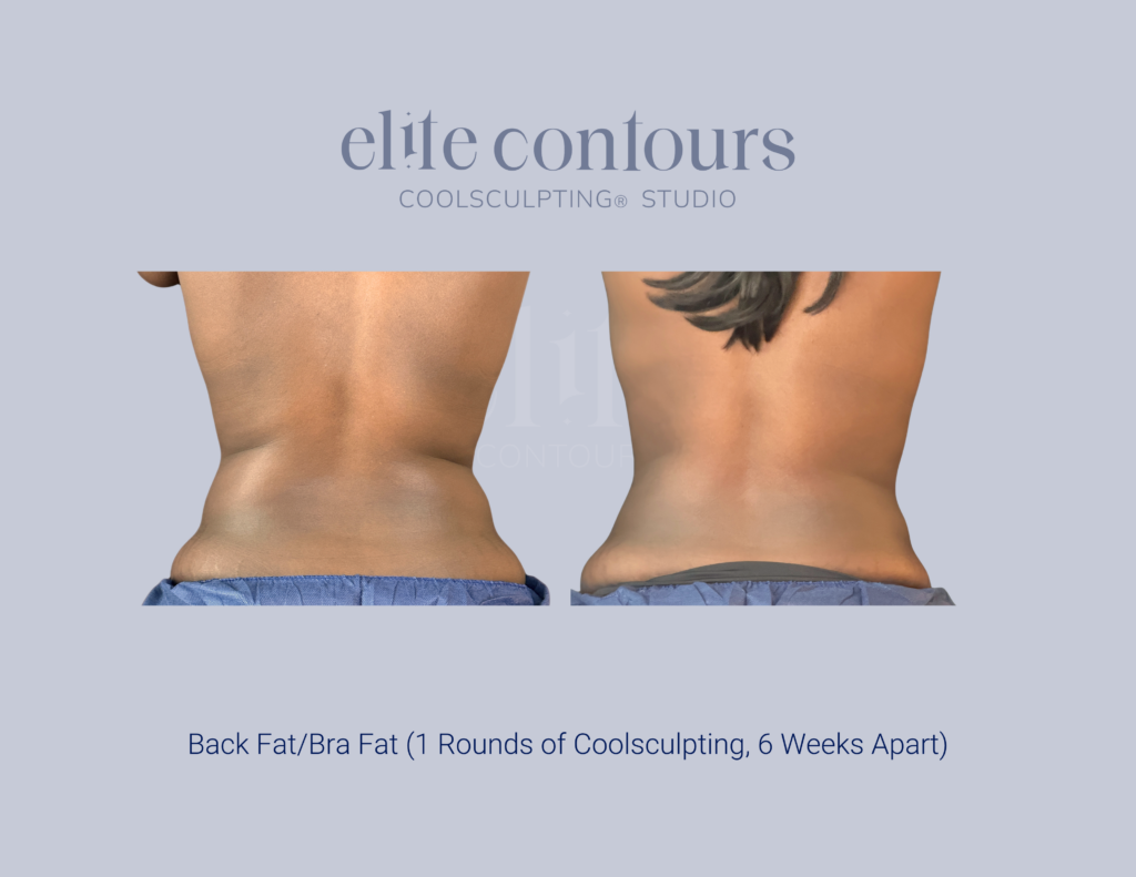 CoolSculpting flanks before and after Lewisville TX