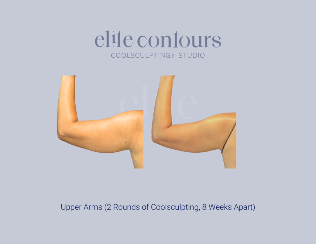 CoolSculpting arms before and after Lewisville TX
